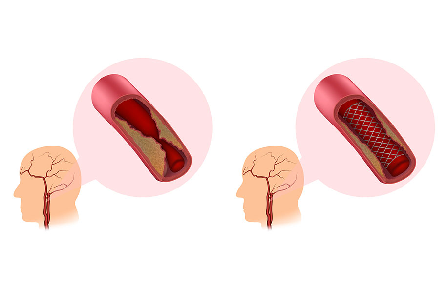 atherome carotidien